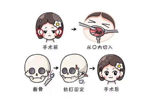 下頜骨手術(shù)費(fèi)用大概多少