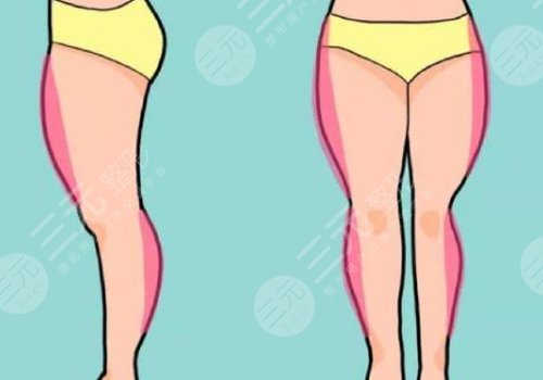 大腿抽脂疼嗎