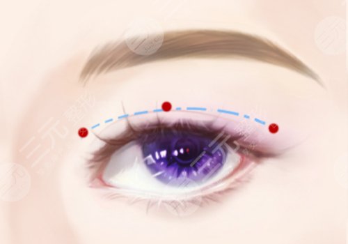 弋磯山醫(yī)院雙眼皮價(jià)格
