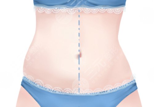 腰部環(huán)形吸脂手術(shù)大概多少錢