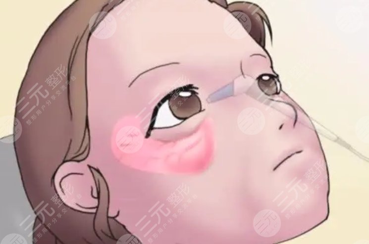 眼袋