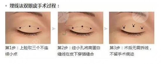 臺(tái)州中心醫(yī)院做雙眼皮要預(yù)約嗎?