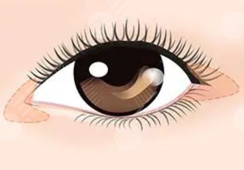 于芷晗醫(yī)生做眼睛價(jià)位