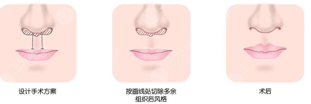 人中縮短