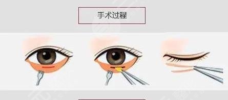徐醫(yī)附院祛眼袋多少錢?