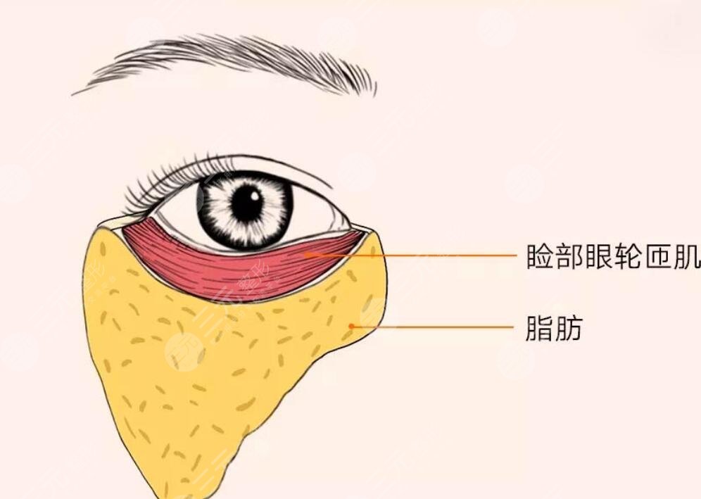 淚溝填充