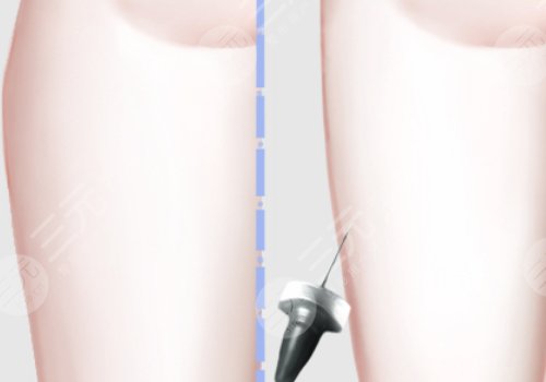 大腿吸脂手術(shù)