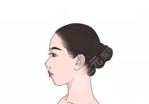 下頜角手術(shù)后遺癥是什么