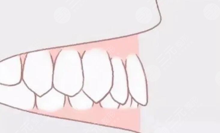 深覆合矯正