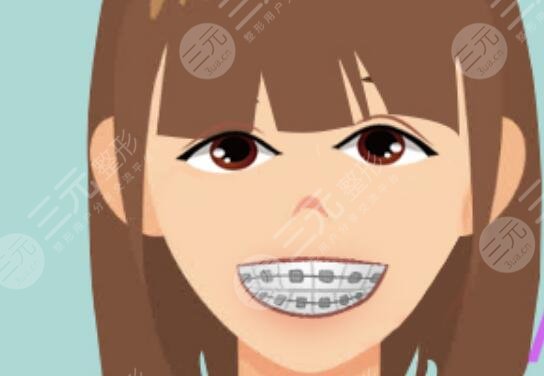牙套臉
