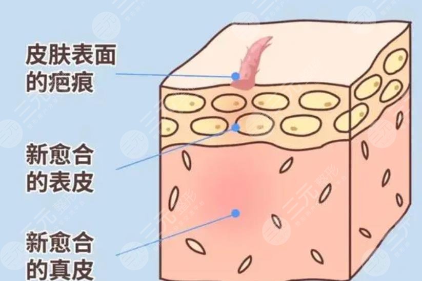 瘢痕