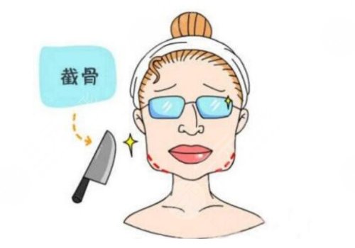 下頜角手術(shù)一個(gè)月效果