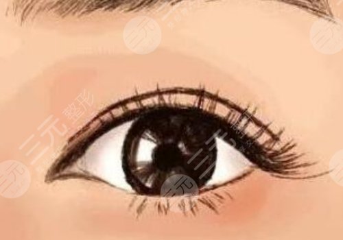 雙眼皮凹陷了怎么補救