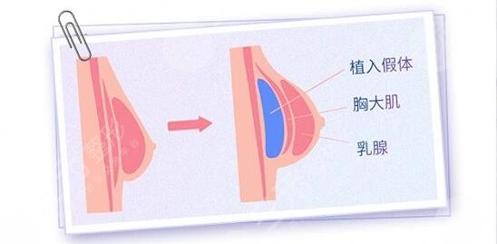 隆胸項目
