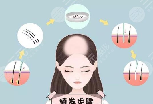 植發(fā)