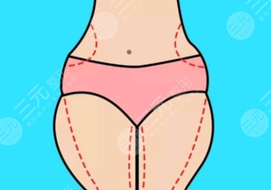 大腿抽脂