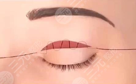 雙眼皮