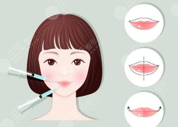 玻尿酸豐唇