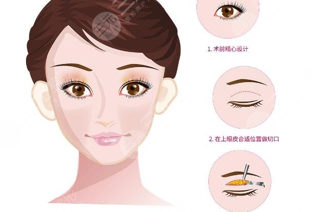 雙眼皮手術