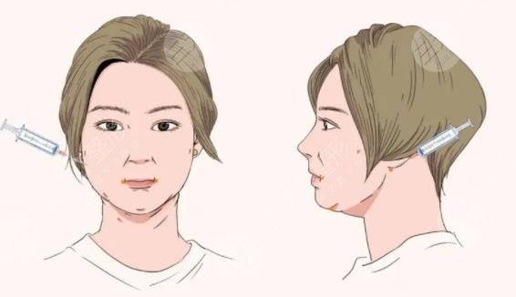 面部吸脂