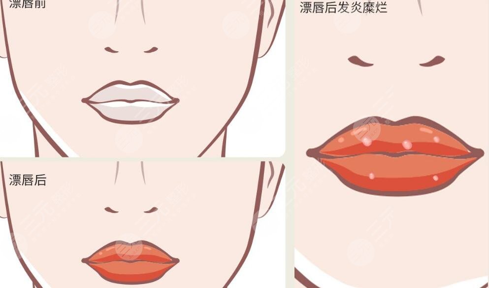 紋唇
