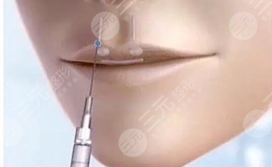 豐唇