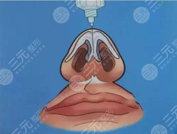 注射隆鼻