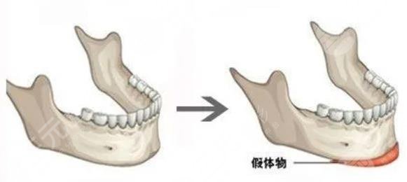 墊下巴