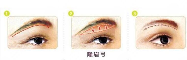 隆眉弓