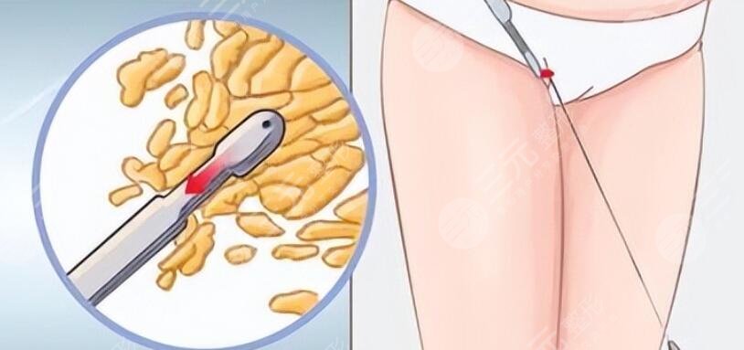 小腿吸脂