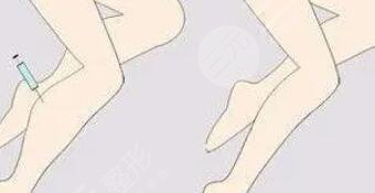 吸脂