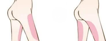 吸脂