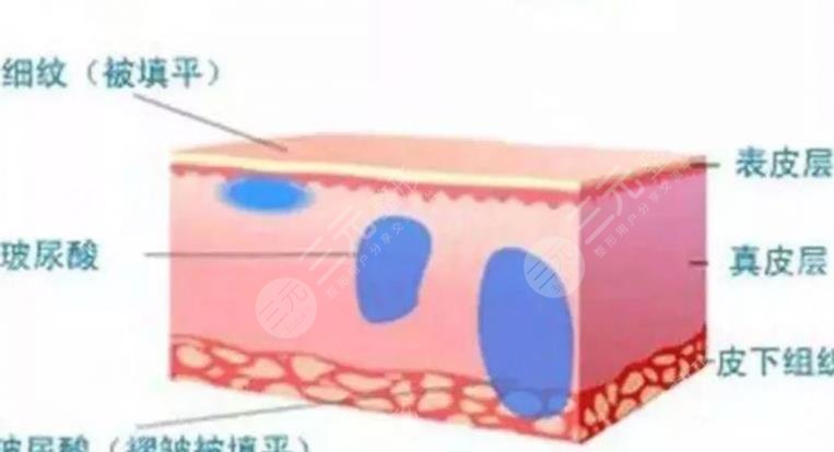 玻尿酸