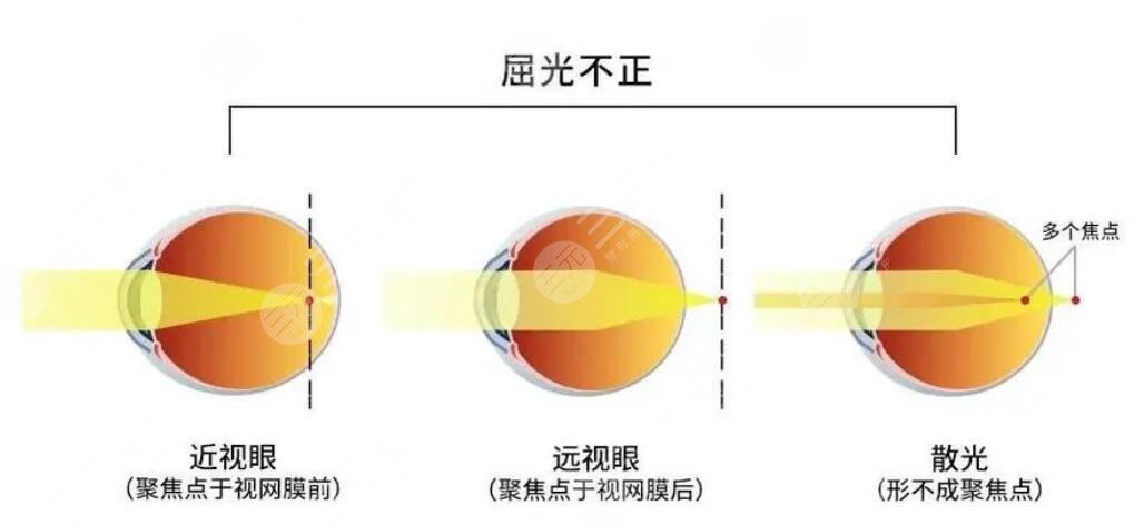 屈光不正