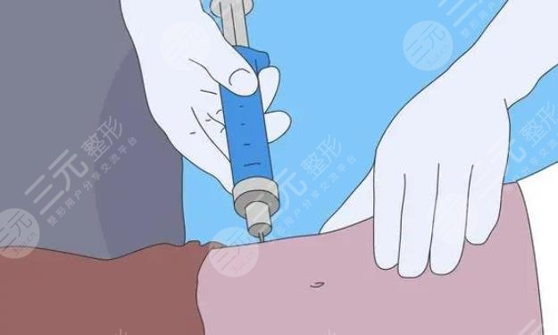 吸脂