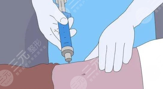 吸脂