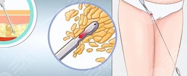 吸脂