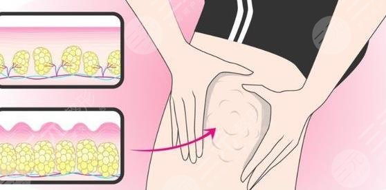 吸脂
