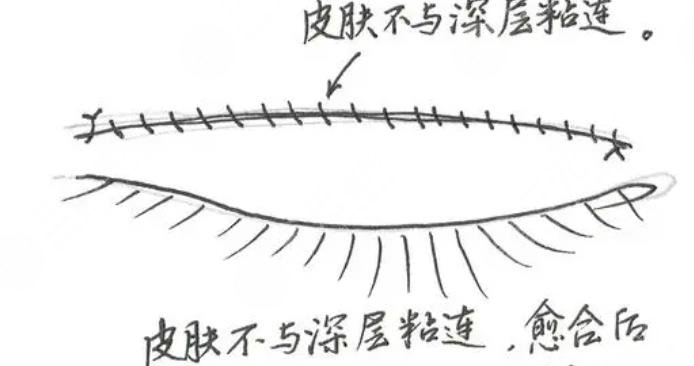 雙眼皮