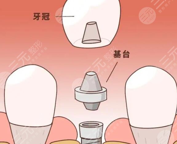 牙齒種植