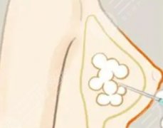 自體脂肪隆胸的危害和后遺癥有哪些？適合人群有哪些？