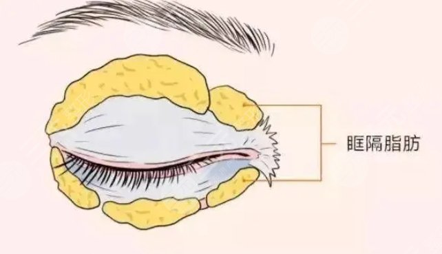 腫眼泡