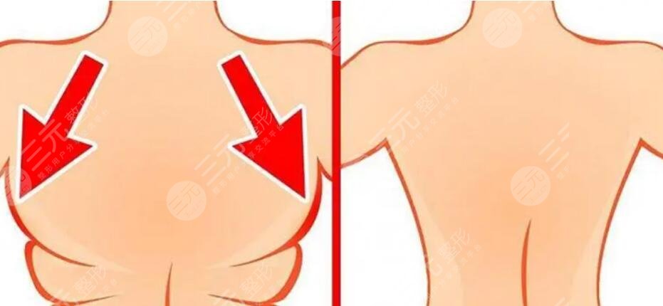 背部吸脂