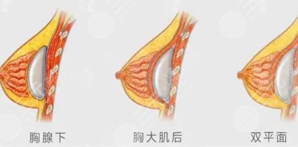 隆胸
