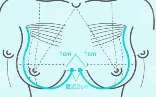 隆胸