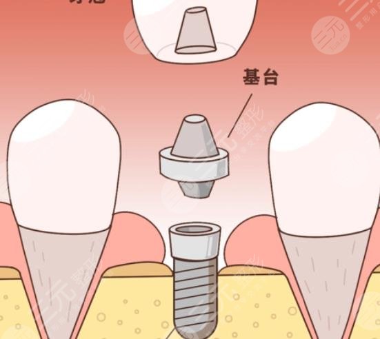 牙齒種植