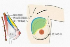 復(fù)合隆胸脂肪存活率高嗎？一般可以維持多長(zhǎng)時(shí)間呢？