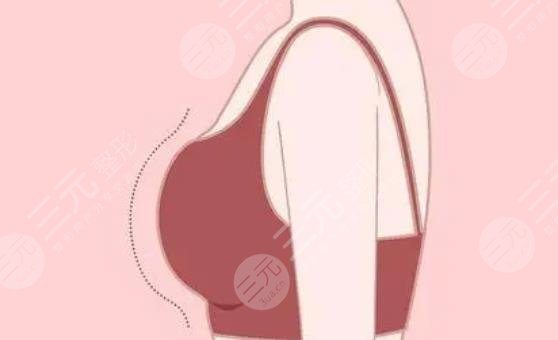 隆胸