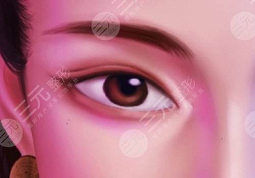 李圣利醫(yī)生雙眼皮修復(fù)怎么樣