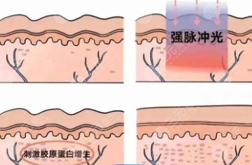 超聲炮